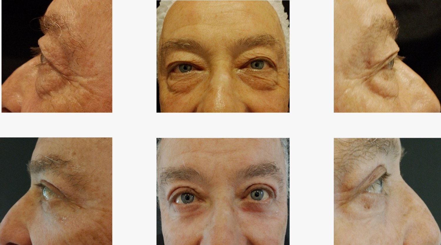 Secuencia clínica comparativa de blefaroplastía realizada en el área periocular